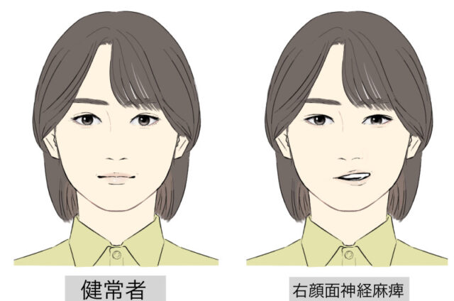 顔面神経麻痺、ベル麻痺、ルート治療、ルート鍼、福岡市南区