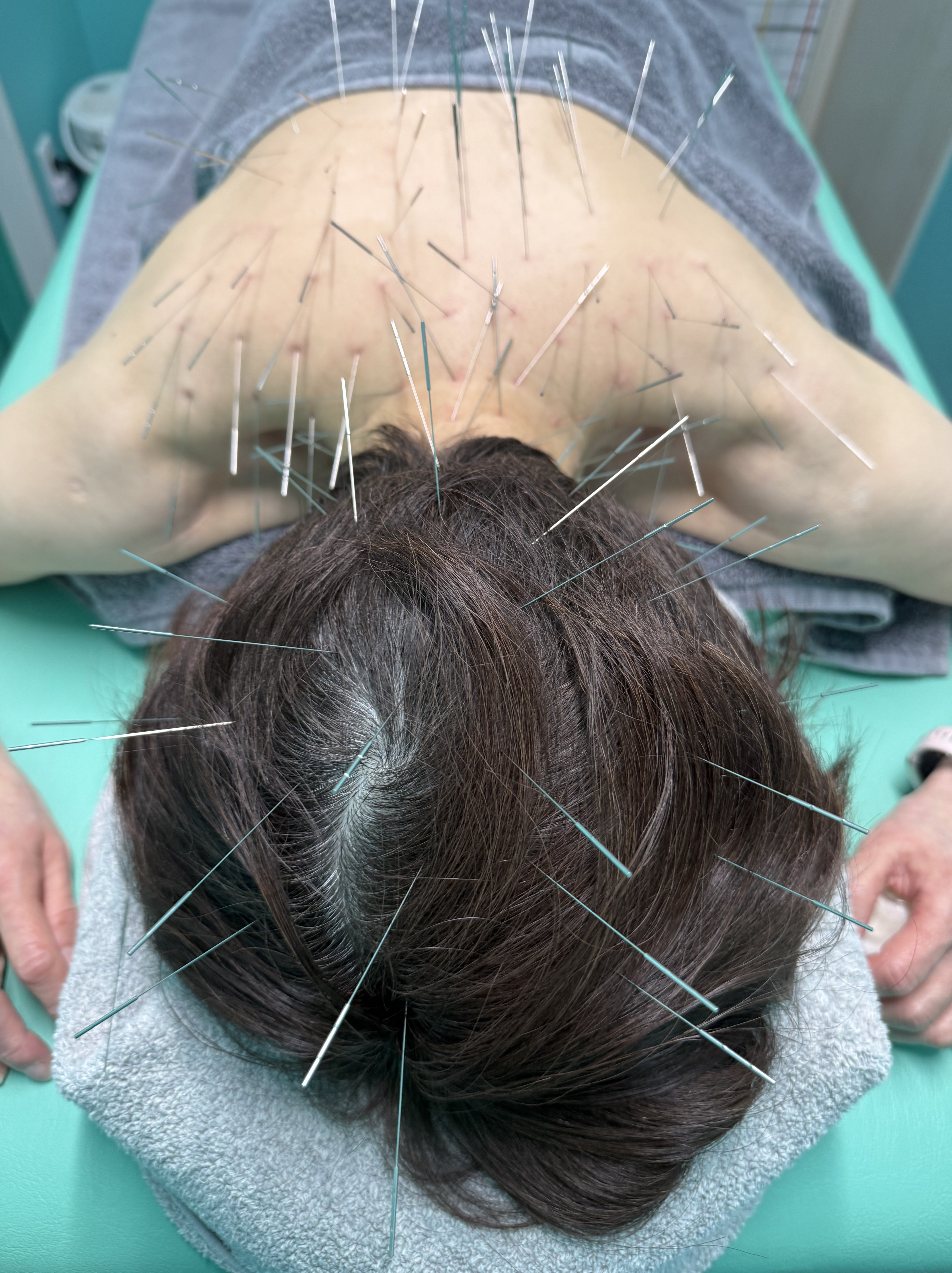 自律神経、うつ病、パニック障害、適応障害、ルート治療、ルート鍼、福岡市南区、高宮駅