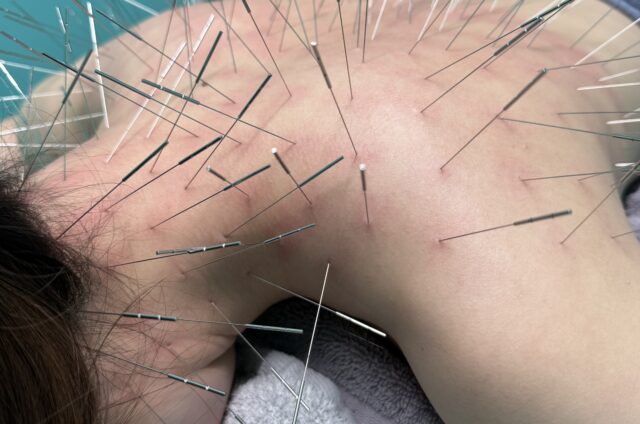 ギックリ首、ぎっくり首、ルート治療、ルート鍼、福岡市南区、高宮駅