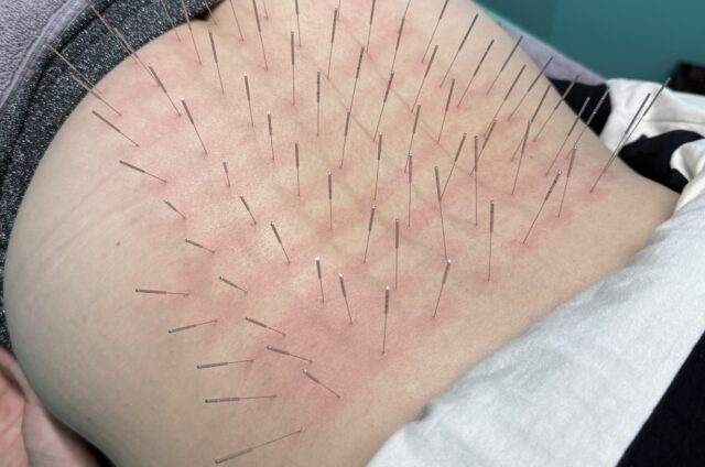 ギックリ腰、ぎっくり腰、腰痛、福岡市南区、ルート治療、ルート鍼