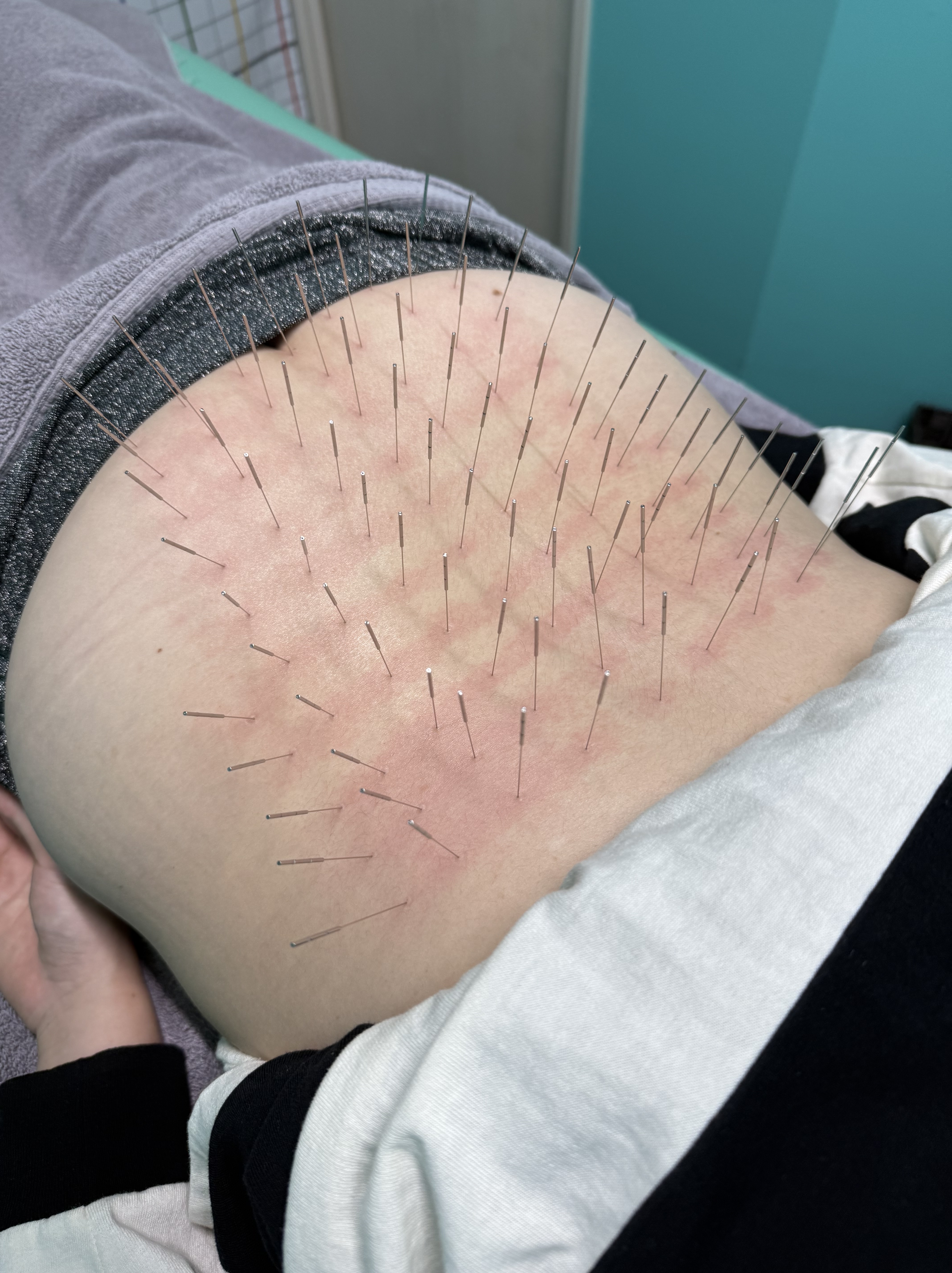 ギックリ腰、ぎっくり腰、腰痛、福岡市南区、ルート治療、ルート鍼