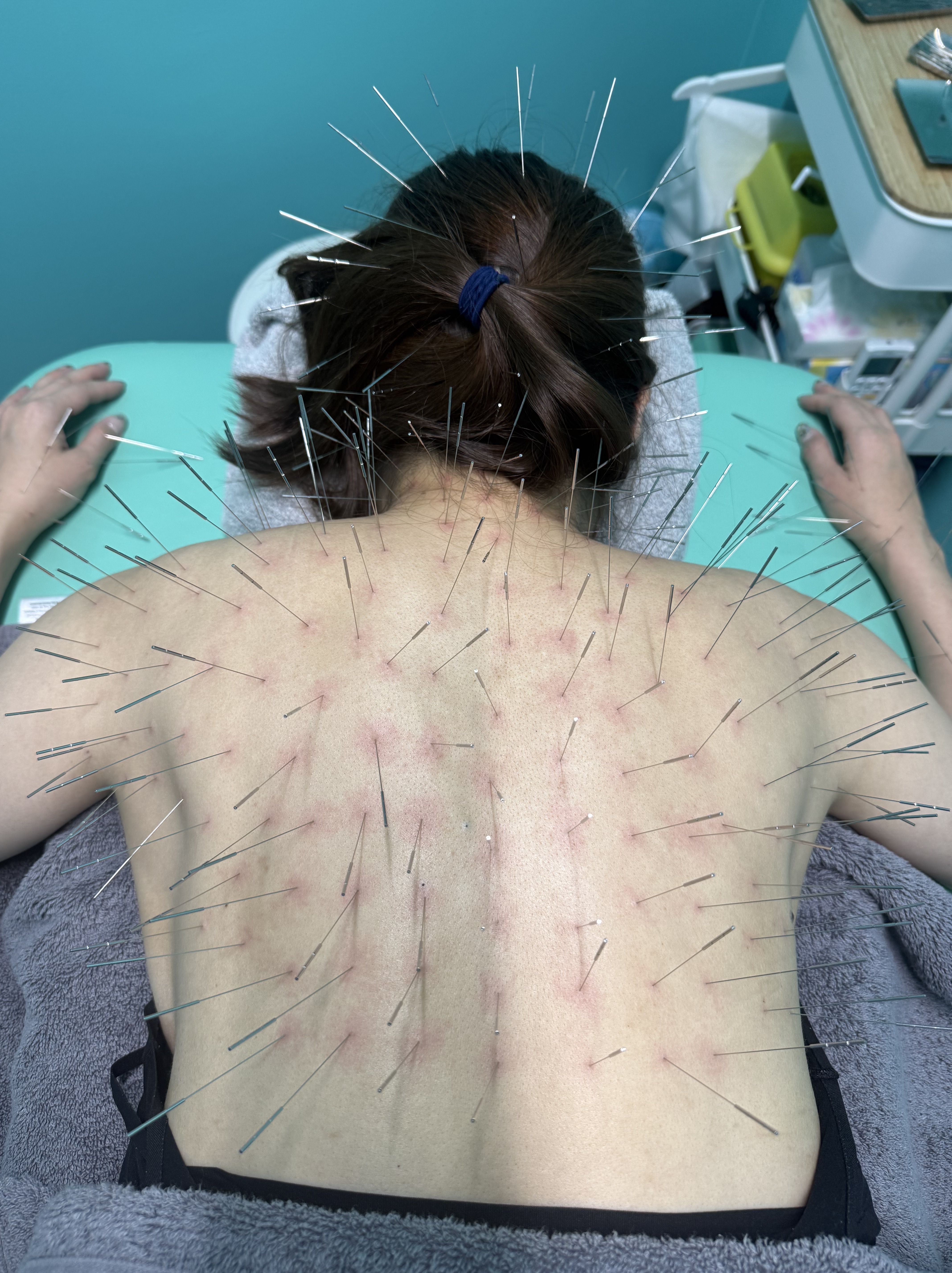 パニック障害、自律神経失調症、自律神経、ルート治療、ルート鍼、福岡市南区、高宮駅