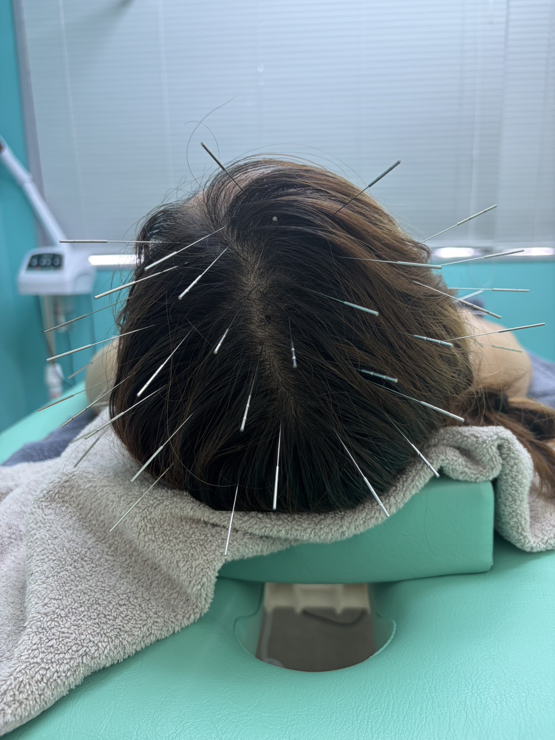 鍼灸、福岡市南区、ルート鍼、ルート治療、首肩コリ、頭痛、不眠
