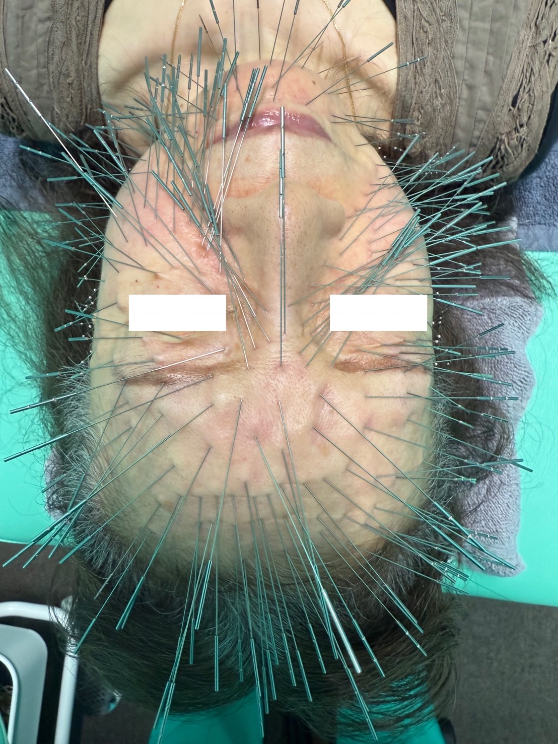 杯瘤腫（はいりゅうしゅ）、ルート治療、ルート鍼、福岡市南区、美容鍼、小顔矯正