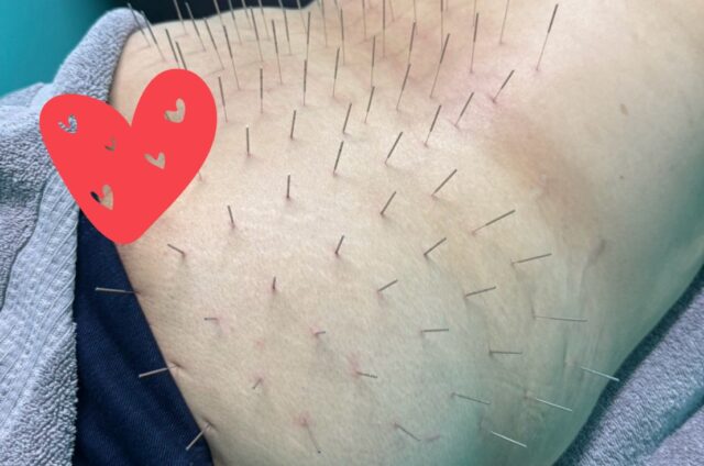 腰椎ヘルニア、腰痛、坐骨神経痛、ルート治療、ルート鍼、福岡市南区