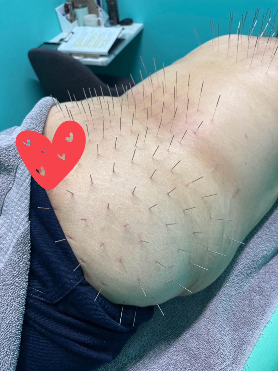 腰椎ヘルニア、腰痛、坐骨神経痛、ルート治療、ルート鍼、福岡市南区