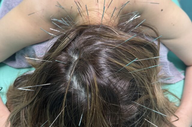 ルート治療、ルート鍼、寝違え、首コリ、肩こり、福岡市南区