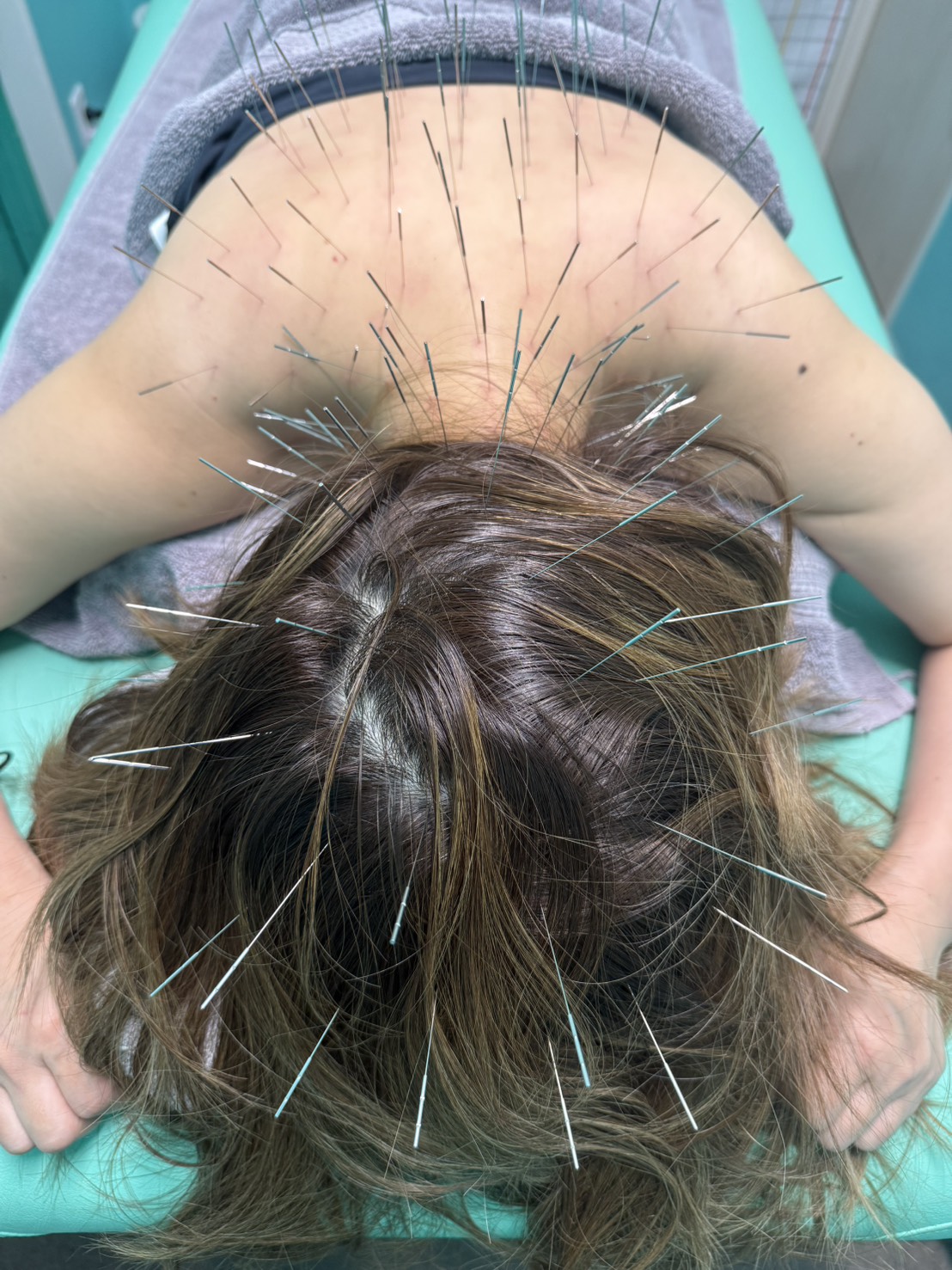 ルート治療、ルート鍼、寝違え、首コリ、肩こり、福岡市南区