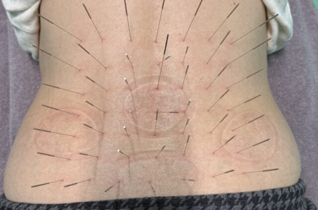 ギックリ腰、ぎっくり腰、初期処置、ルート治療、ルート鍼、福岡市南区