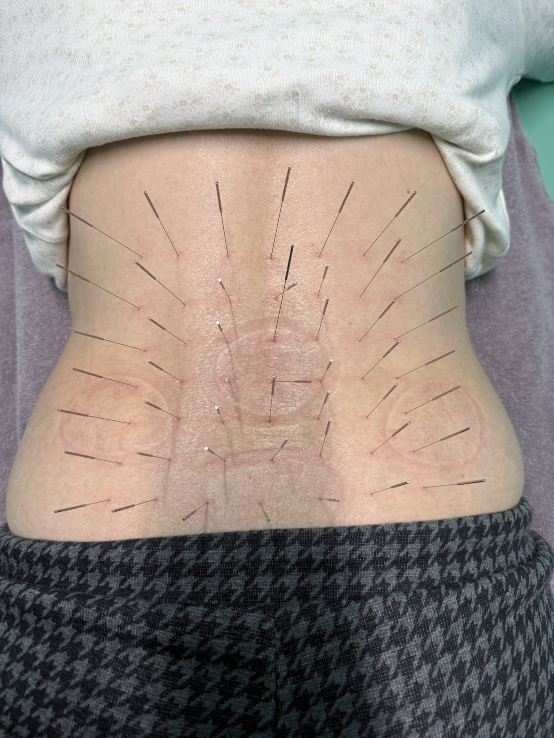 ギックリ腰、ぎっくり腰、初期処置、ルート治療、ルート鍼、福岡市南区