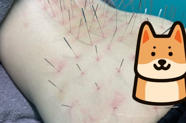 坐骨神経痛、大殿筋、中殿筋、ルート治療、ルート鍼、福岡市南区