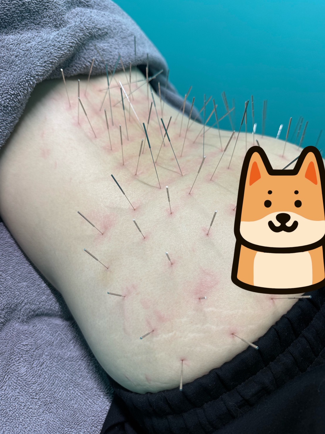 坐骨神経痛、大殿筋、中殿筋、ルート治療、ルート鍼、福岡市南区