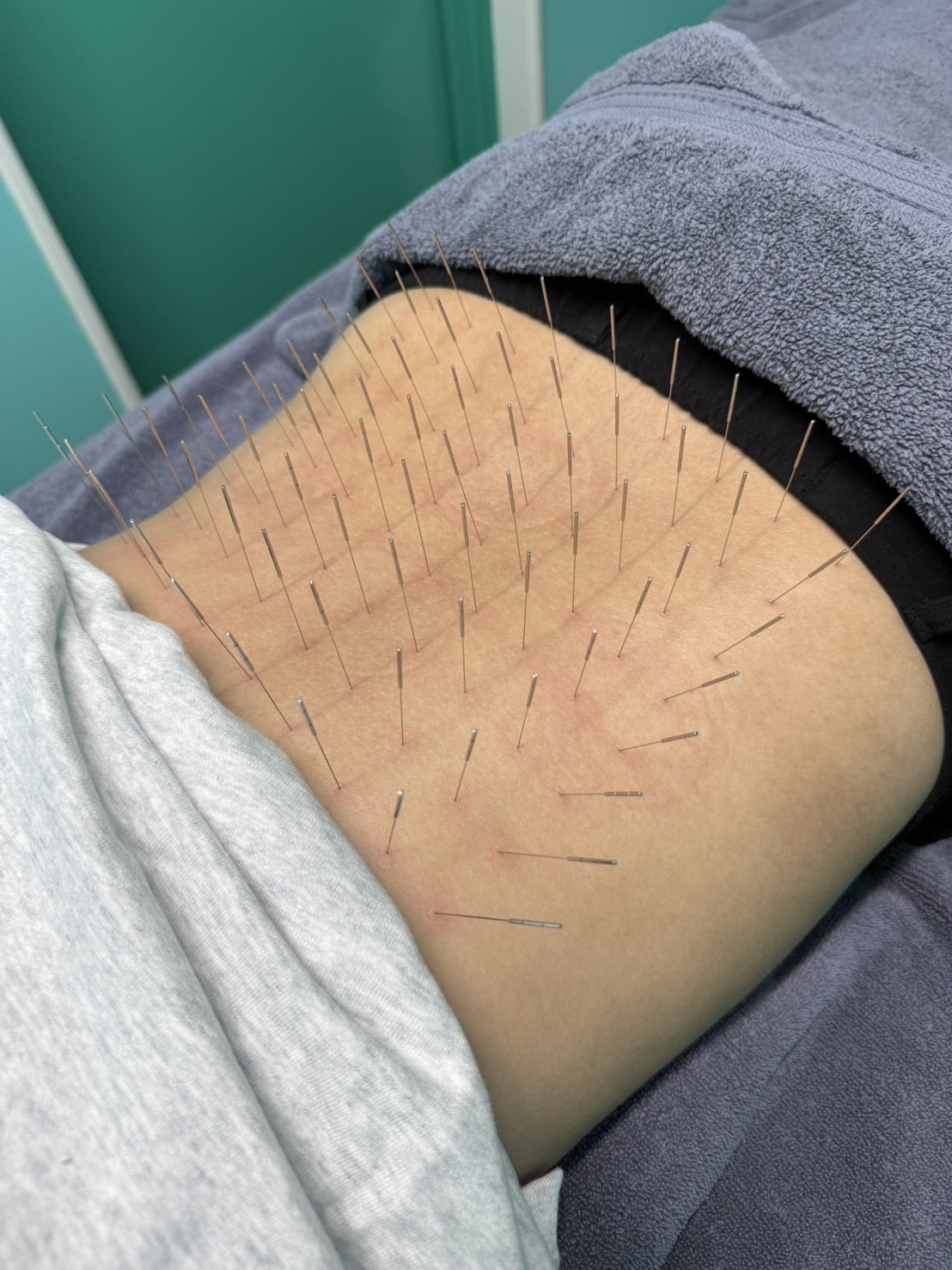 ルート治療、ルート鍼、高宮駅、福岡市南区、多賀宏之