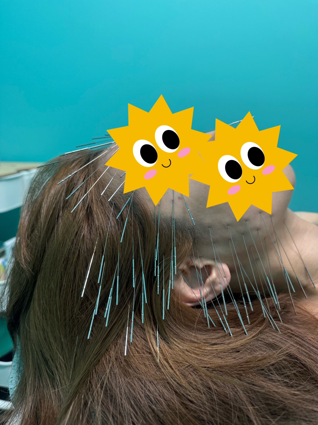 顎関節症、顎関節脱臼、福岡市南区、高宮駅、高宮レディース鍼灸整骨院