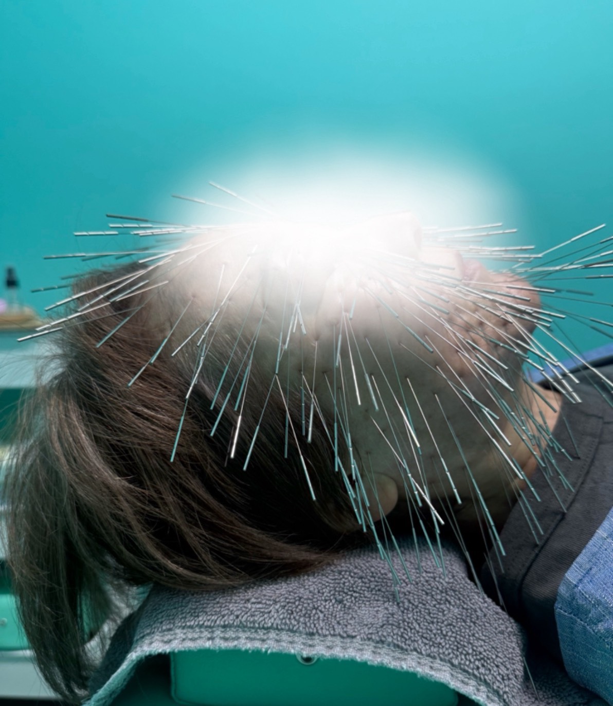 ルート治療、ルート鍼、小顔矯正、美容鍼、福岡市南区、高宮駅