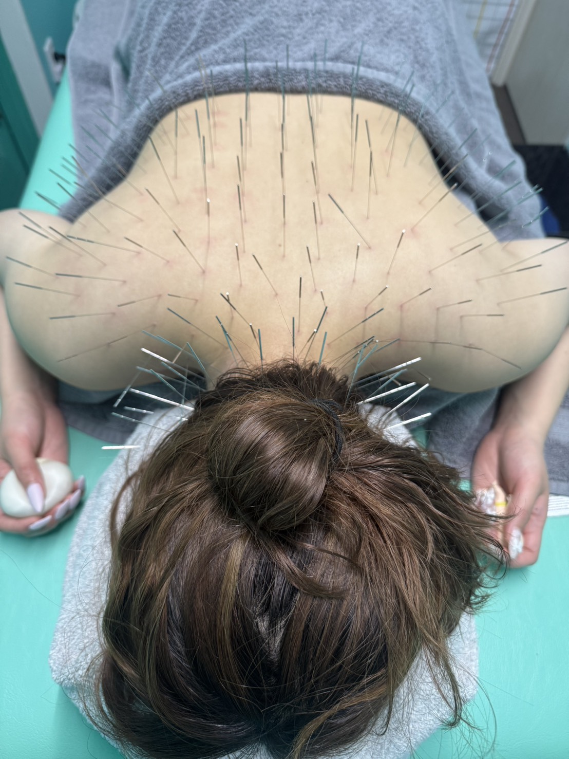 寝違え、頸椎ヘルニア、頚椎ヘルニア、首の痛み、福岡市南区、ルート治療、ルート鍼、高宮駅