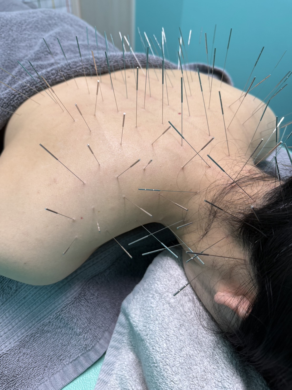 ルート治療、ルート鍼、福岡市、根本改善、高宮駅、鍼治療