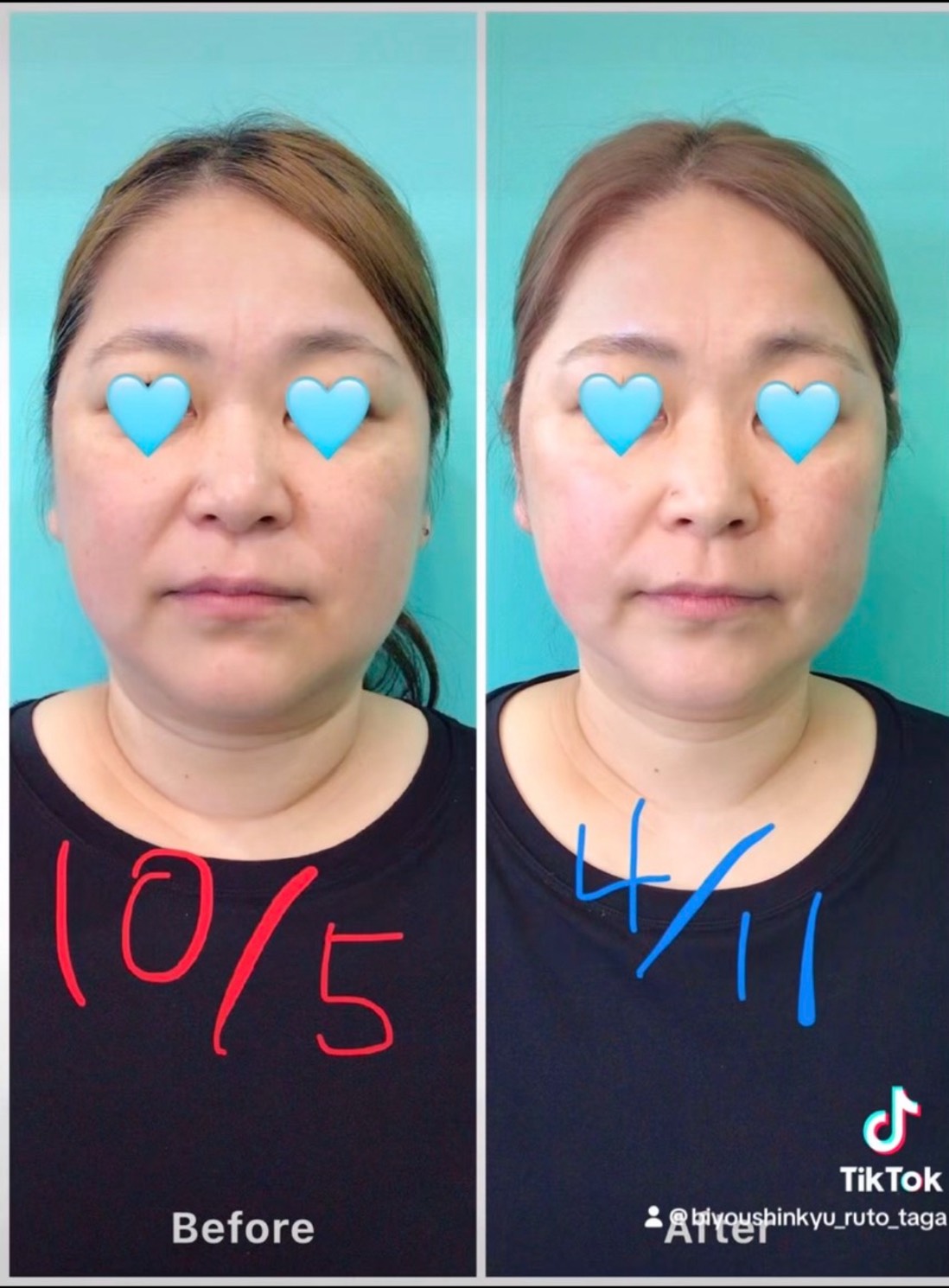 小顔、小顔矯正、美容鍼、ルート治療、ルート鍼、福岡市南区、高宮駅